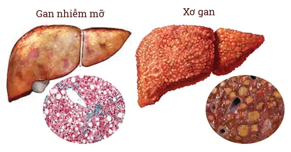 Nguyên nhân chính gây ra gan to nhiễm mỡ