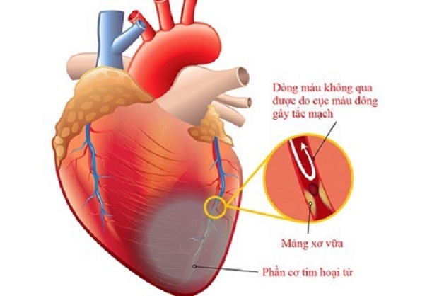 Nguyên nhân, cơ chế và chẩn đoán bệnh mạch vành cấp