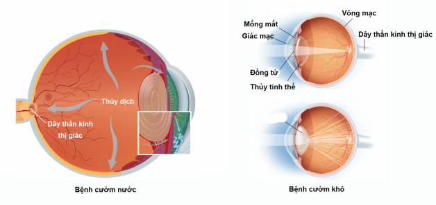 Nguyên nhân của bệnh đục thủy tinh thể người già là gì?