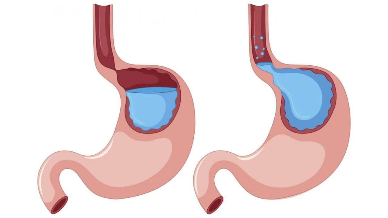 Nguyên nhân của trào ngược dạ dày và cách chẩn đoán