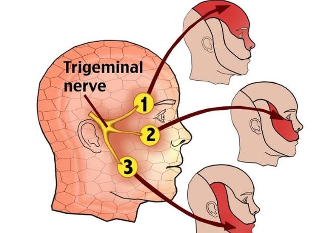 Nguyên nhân dẫn đến bệnh viêm dây thần kinh số 5