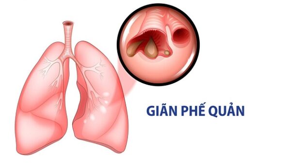 Nguyên nhân dẫn đến giãn phế quản do đâu?