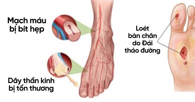 Nguyên nhân đau dây thần kinh ngoại biên