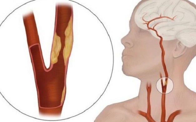 Nguyên nhân đột quỵ não do sử dụng cocaine