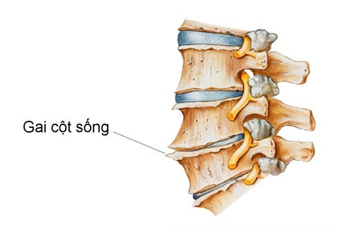 Nguyên nhân gai cột sống và cách phòng ngừa