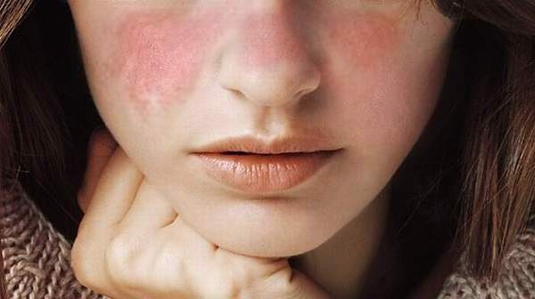 Nguyên nhân gây bệnh lupus ban đỏ