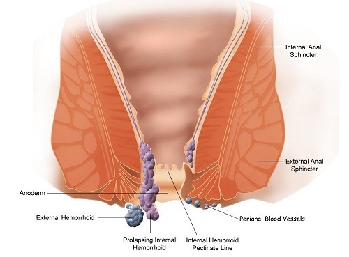 Nguyên nhân gây bệnh trĩ hỗ trợ điều trị sớm