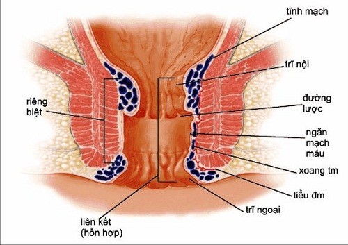 Nguyên nhân gây bệnh trĩ nội gây ảnh hưởng nhiều