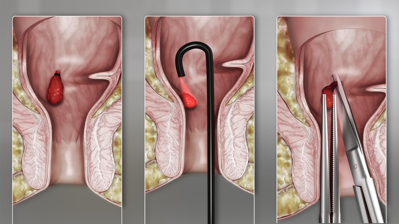 Nguyên nhân gây bệnh trĩ và cách điều trị trĩ hiện nay