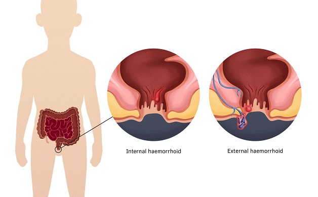 Nguyên nhân gây bệnh trĩ và cách điều trị trĩ hiện nay