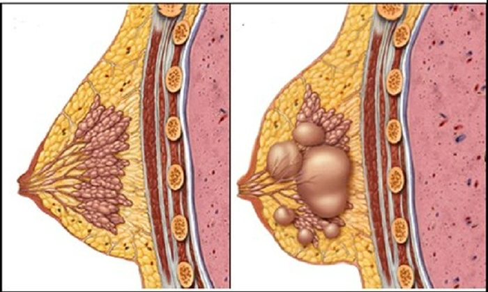 Nguyên nhân gây chứng đau đầu nhũ hoa ở nữ giới