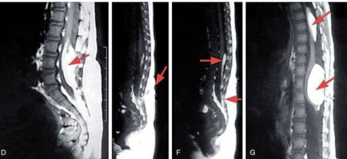 Nguyên nhân gây đau lưng mất ngủ & biểu hiện của bệnh lý