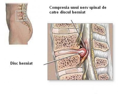 Nguyên nhân gây đau thần kinh tọa là gì?