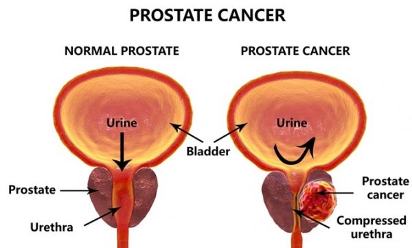 Nguyên nhân gây đi tiểu ra máu ở nam giới