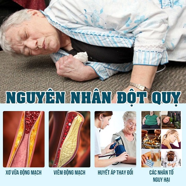 Nguyên nhân gây đột quỵ nhiều người mắc phải