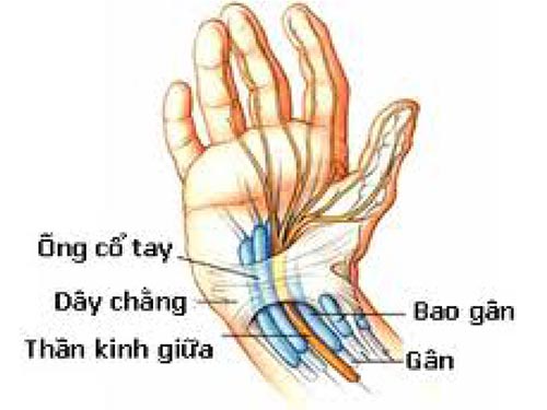 Nguyên nhân gây hội chứng ống cổ tay