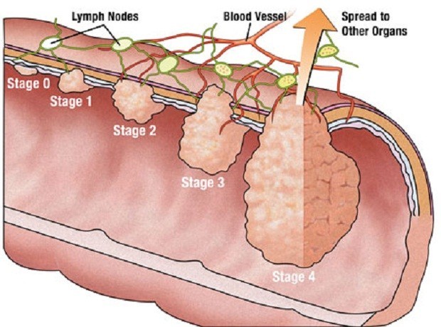 Nguyên nhân gây polyp trực tràng