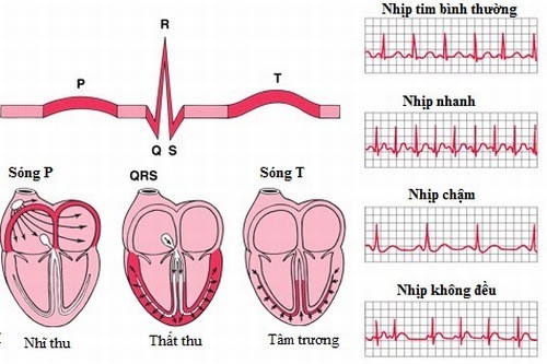 Nguyên nhân gây rối loạn nhịp tim