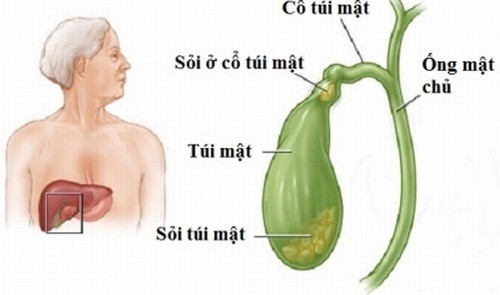 Nguyên nhân gây sỏi mật là gì?