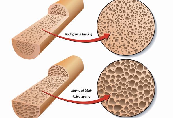 Nguyên nhân gây sỏi thận không phải ai cũng biết