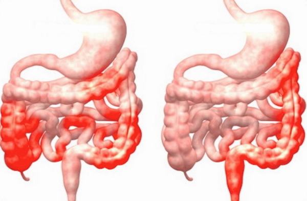 Nguyên nhân gây sỏi thận không phải ai cũng biết