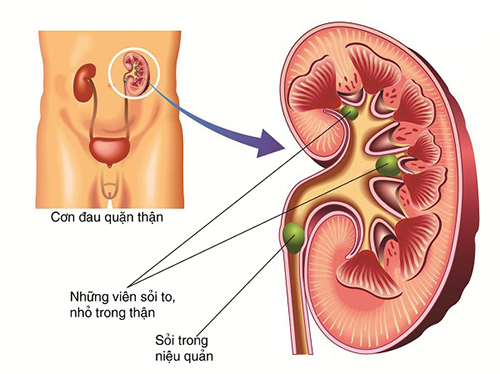 Nguyên nhân gây sỏi tiết niệu thường gặp người trưởng thành