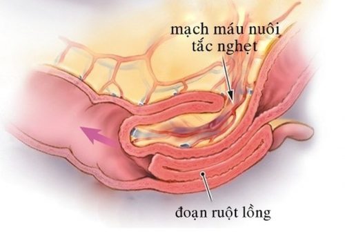 Nguyên nhân gây tắc nghẽn đường ruột