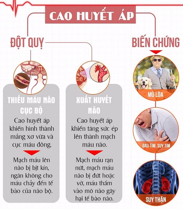 Nguyên nhân gây tai biến và cách phòng tránh hiệu quả