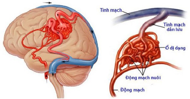 Nguyên nhân gây tai biến và cách phòng tránh hiệu quả