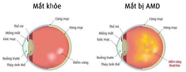 Nguyên nhân gây thoái hóa hoàng điểm ở người trẻ