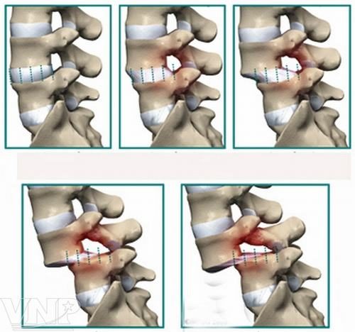 Nguyên nhân gây Trật Khớp Cột Sống Thắt Lưng & Triệu chứng để biết