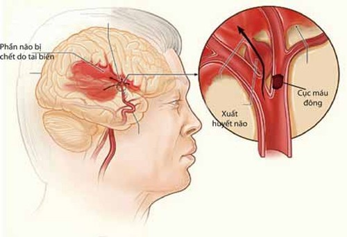 Nguyên nhân gây xuất huyết não bạn cần biết