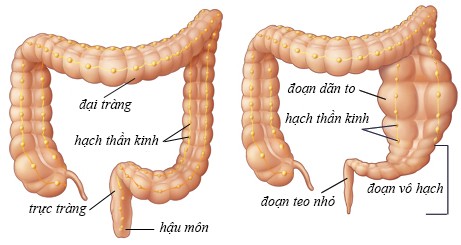 Nguyên nhân giãn đại tràng ở thai nhi triệu chứng của bệnh