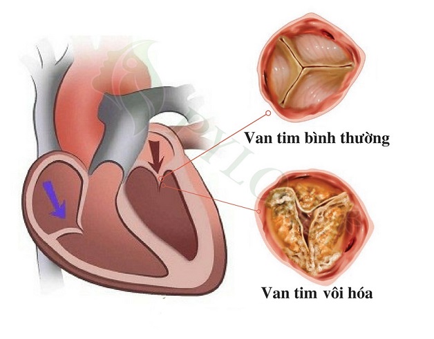 Nguyên nhân hẹp van tim 2 lá bạn cần biết