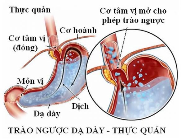 Nguyên nhân khiến trẻ sơ sinh bị trào ngược dạ dày thực quản