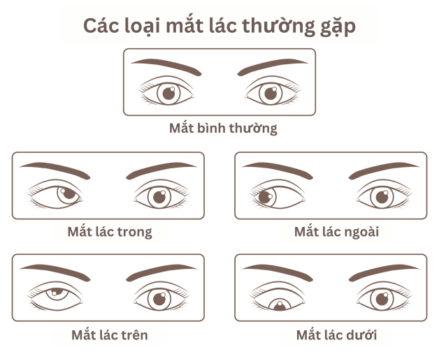 Nguyên nhân mắt bị lác nhẹ và cách tự cải thiện tại nhà