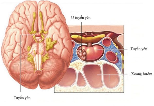 Nguyên nhân mất ngủ kéo dài do u tuyến yên