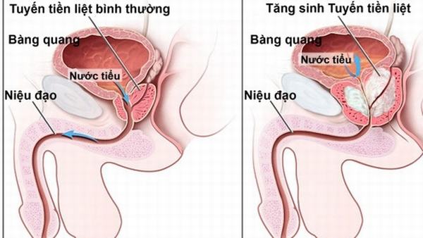 Nguyên nhân nào làm tăng sản xuất tuyến tiền liệt