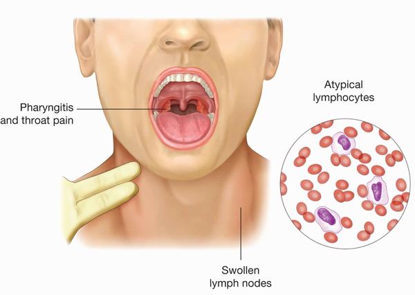 Nguyên nhân nhiễm virus EBV