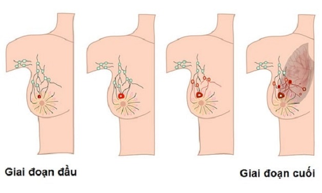 Nguyên nhân nổi hạch ở nách là gì?