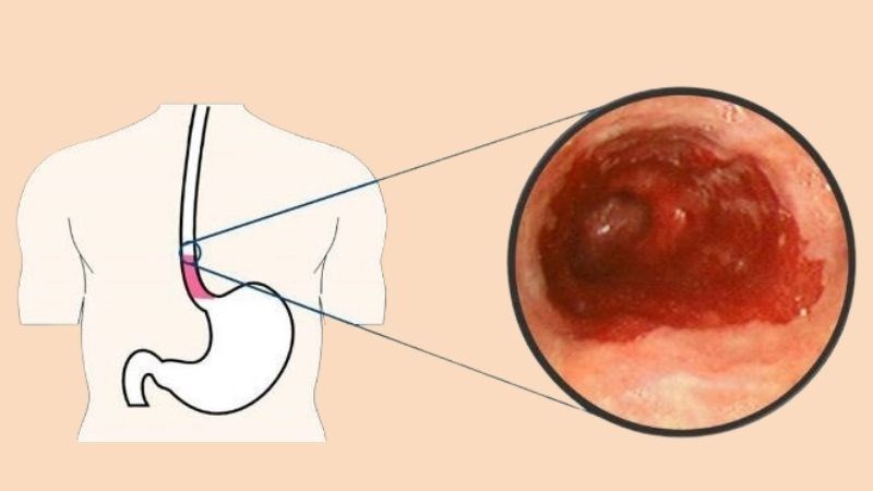 Nguyên nhân ợ hơi nhiều sau uống rượu bia