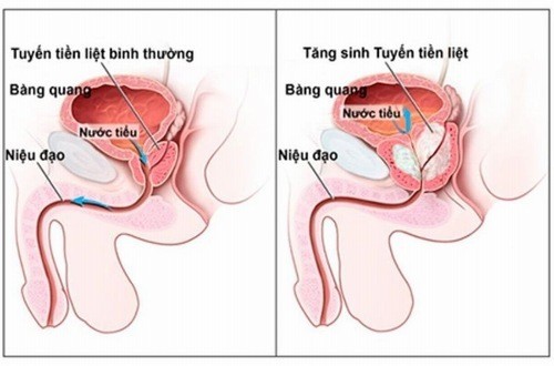 Nguyên nhân phì đại tuyến tiền liệt