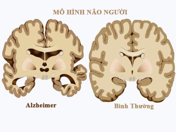 Nguyên nhân suy giảm trí nhớ ở người trẻ