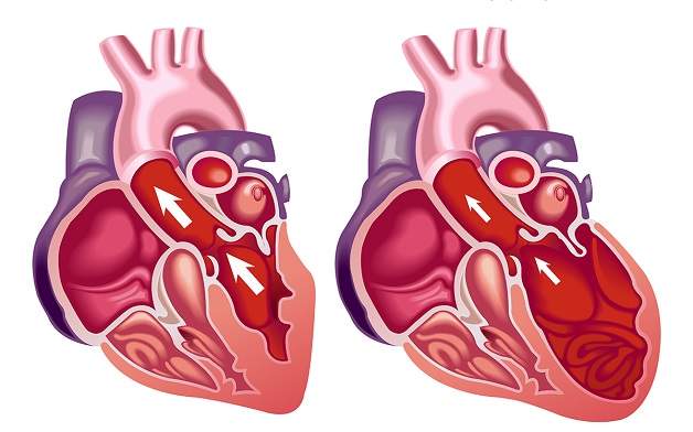 Nguyên nhân suy tim phải và hậu quả khó lường