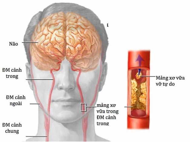 Nguyên nhân tai biến mạch máu não có thể phòng ngừa