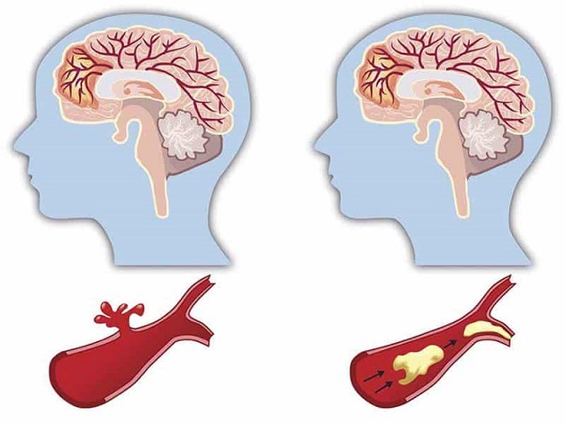 Nguyên nhân tai biến mạch máu não theo từng dạng tai biến