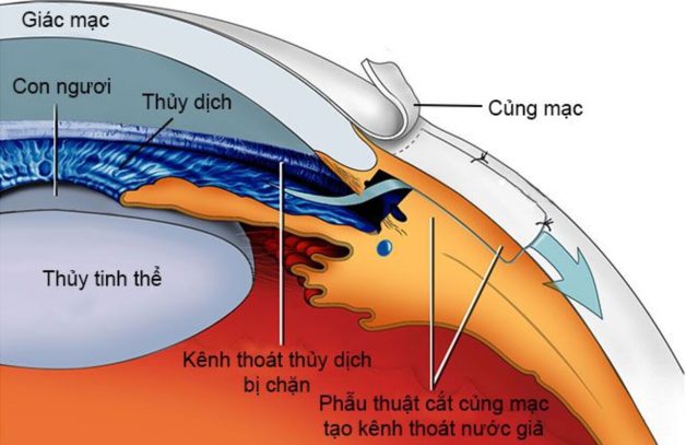 Nguyên nhân tăng nhãn áp và cách điều trị chuẩn bác sĩ