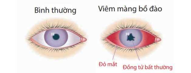 Nguyên nhân tăng nhãn áp và cách điều trị chuẩn bác sĩ