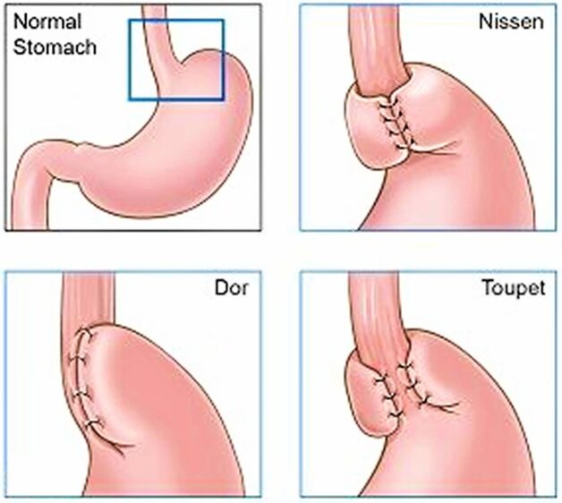 Nguyên nhân trào ngược dịch mật