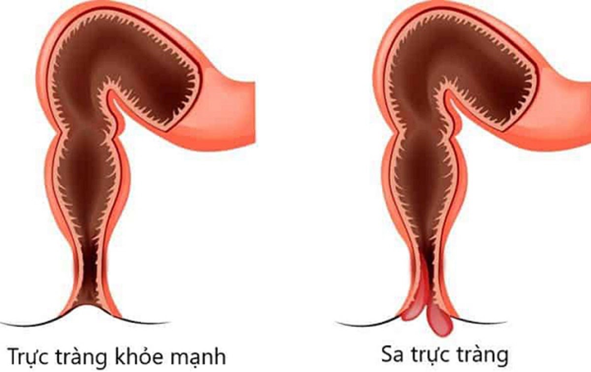 Nguyên nhân, triệu chứng của bệnh sa trực tràng